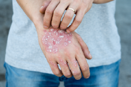 allergy