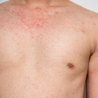 dengue_img6